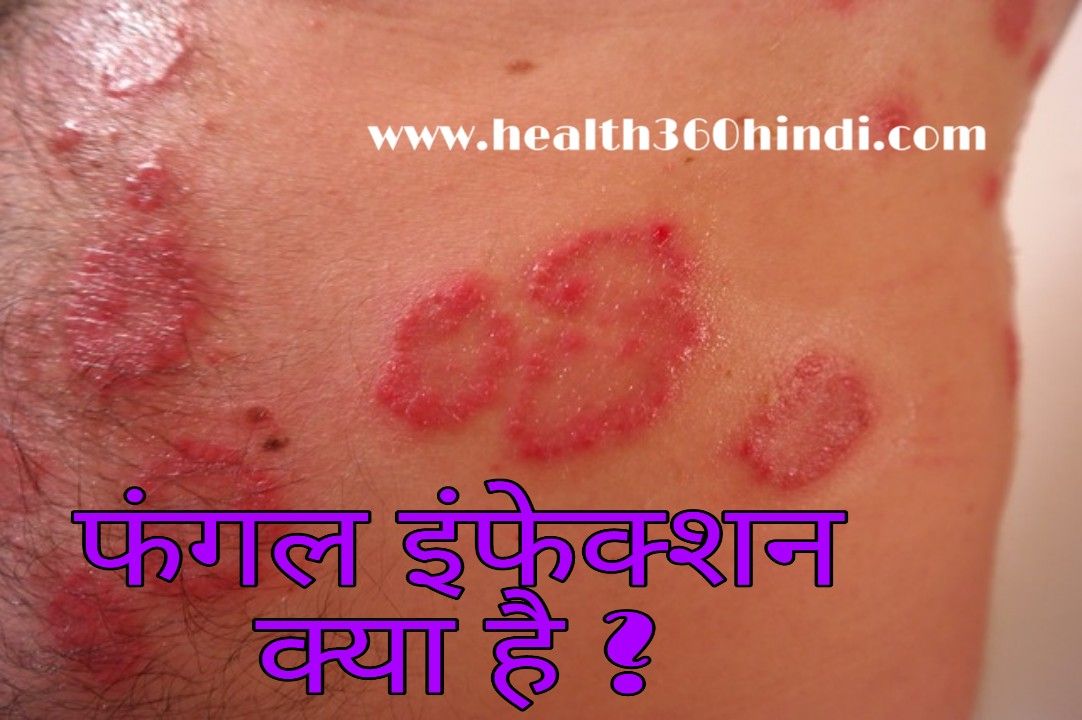 fungal-infection-in-hindi